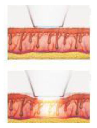 Laser a diodo per epilazione di ultima generazione SPA LASER PLUS